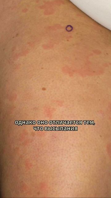 Крапивница VS уртикарный васкулит