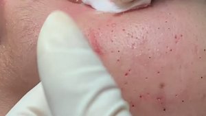 Множество удивительных черных точек. Удаление.