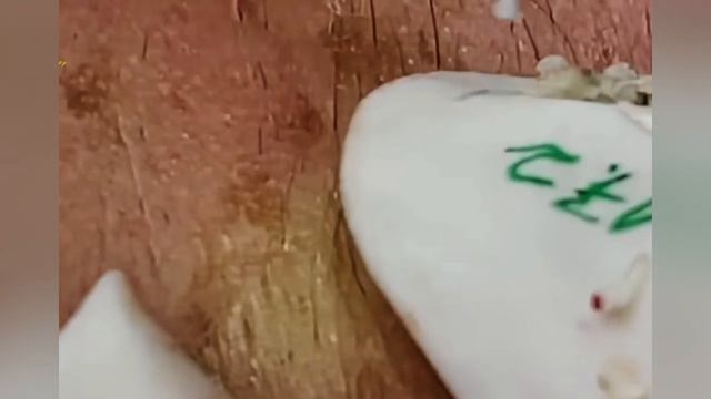 Выдавливание прыщей, угрей, черных точек и камедонов #353