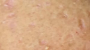 Выдавливание прыщей, угрей, черных точек и камедонов #354