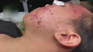 Чистка лица: как мы избавляем от акне и воспалений