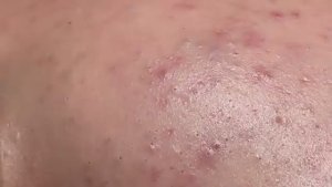 Удаление акне и скрытых прыщей