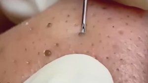 #258 Чистка лица от угрей и акне. Выдавливание прыщей. Удаление черных точек и комедонов