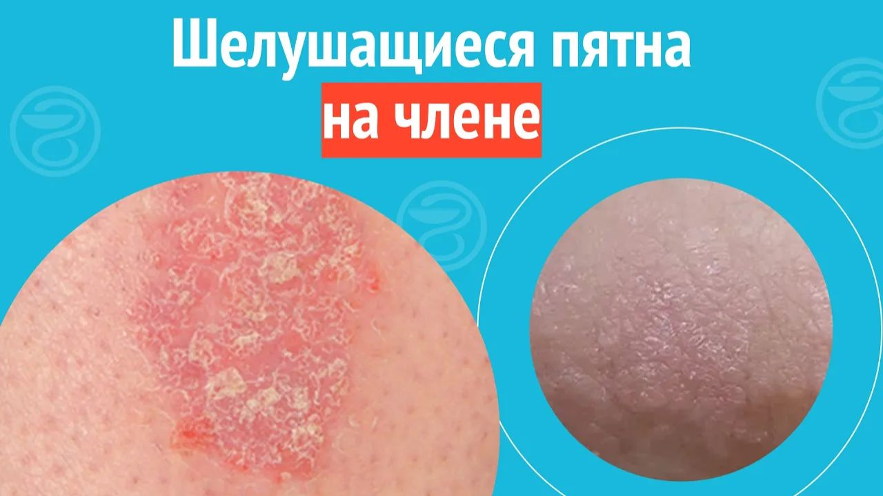 🥺 Шелушащиеся пятна на члене. Клинический случай №1387 смотреть онлайн
