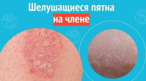 🥺 Шелушащиеся пятна на члене. Клинический случай №1387
