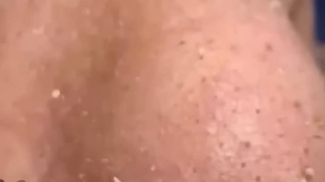 258 Чистка лица от угрей и акне. Выдавливание прыщей. Удаление черных точек и комедонов