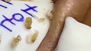 #256 Чистка лица от угрей и акне. Выдавливание прыщей. Удаление черных точек и комедонов