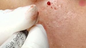 Ликвидация комедонов: наша методика чистки лица