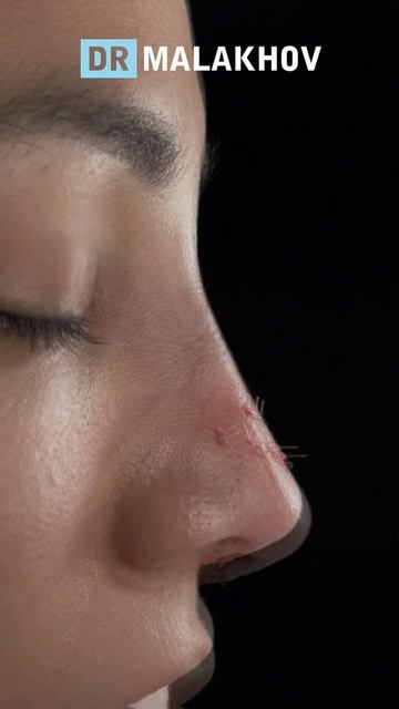 ДО/ПОСЛЕ на операционном столе 👃🏼