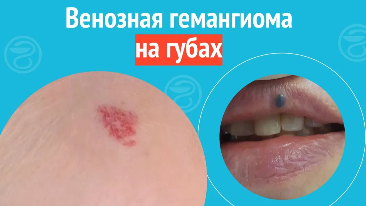 🫦 Венозная гемангиома на губах. Клинический случай №1382 смотреть онлайн