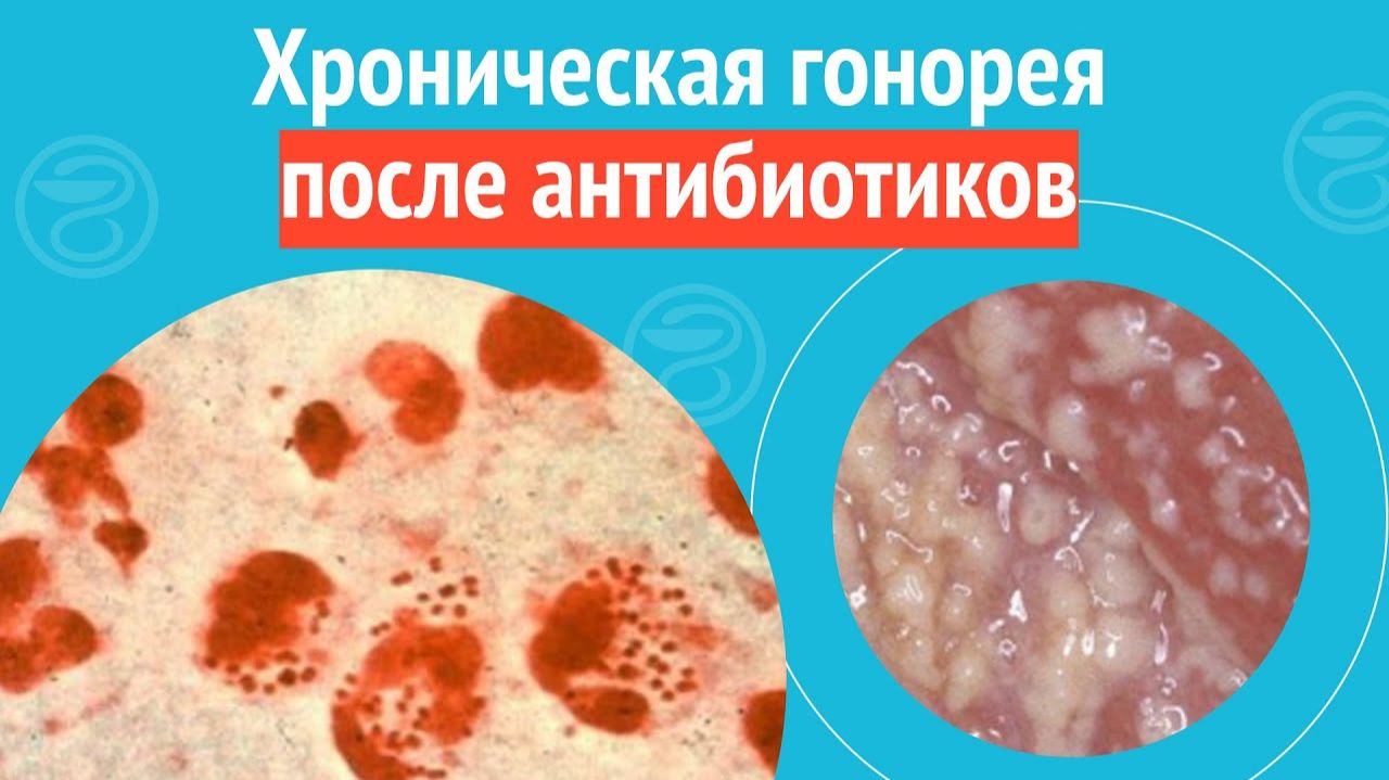 🥺 Хроническая гонорея после антибиотиков. Клинический случай №1392 смотреть онлайн