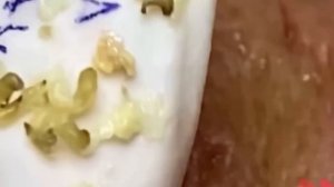 #261 Чистка лица от угрей и акне. Выдавливание прыщей. Удаление черных точек и комедонов