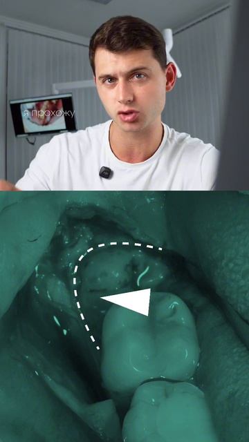 Протокол быстрого и прогнозируемого удаления зуба мудрости