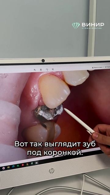 Клинический случай, кариес под коронкой