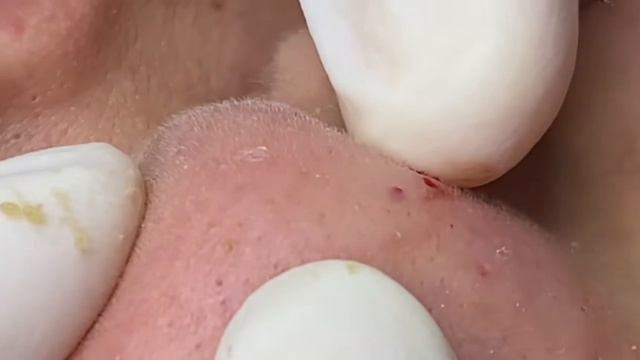 Выдавливание прыщей, угрей, черных точек и камедонов #358