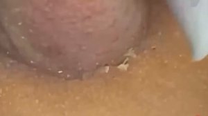 #260 Чистка лица от угрей и акне. Выдавливание прыщей. Удаление черных точек и комедонов