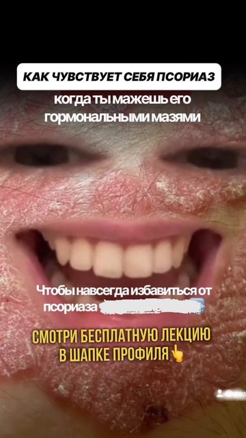Хочешь убрать псориаз без мазей? Смотри бесплатную лекцию по ссылке 👆