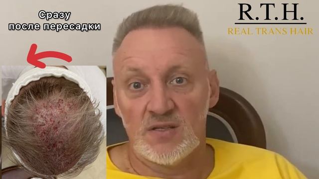 Как изменился выдающийся спортсмен после пересадки волос