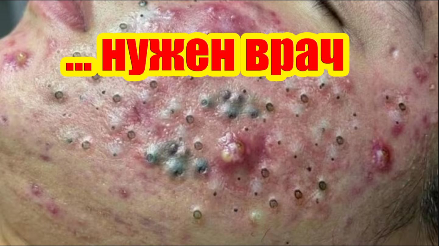 Я никогда не видела никого с таким количеством прыщей