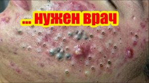 Я никогда не видела никого с таким количеством прыщей