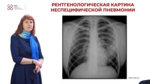 Сутягина Д.А. "Инфильтративный туберкулёз лёгких" (Jalinga) ПИМУ-2025