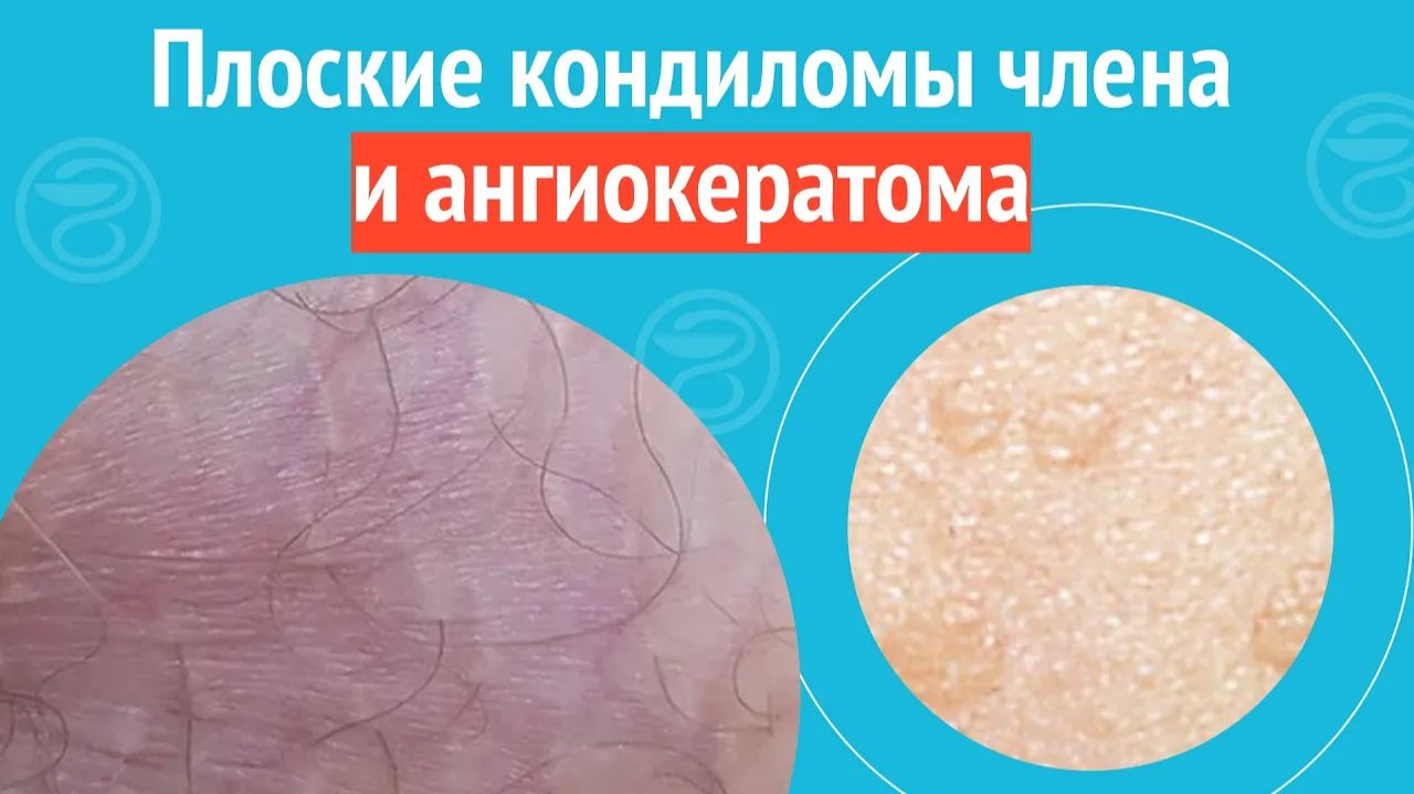 🫤 Плоские кондиломы члена и ангиокератома. Клинический случай №1391 смотреть онлайн