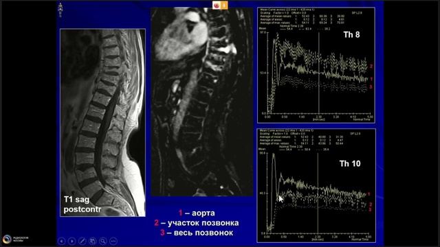 L00385 Опухоли и опухолеподобные заболевания позвоночника. Часть 2 Неред А.С.