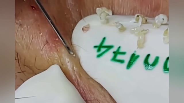 Выдавливание прыщей, угрей, черных точек и камедонов #356