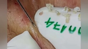 Выдавливание прыщей, угрей, черных точек и камедонов #356