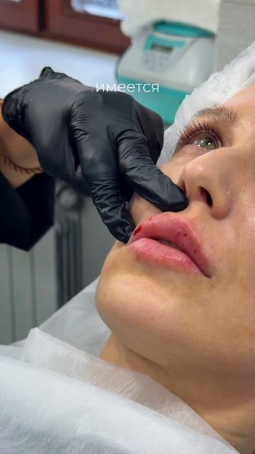 К нам обратилась пациентка, у которой много лет назад был поставлен биополимер.