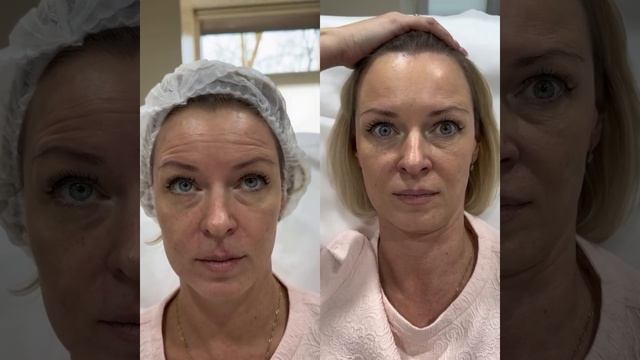 Какие зоны включает ботулинотерапия Full face и за что отвечает каждая из них?