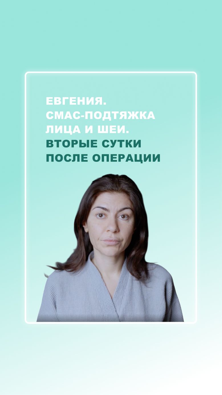 Евгения. СМАС-подтяжка лица и шеи. Вторые сутки после операции