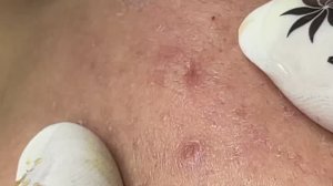 Профессиональная чистка от подкожных угрей