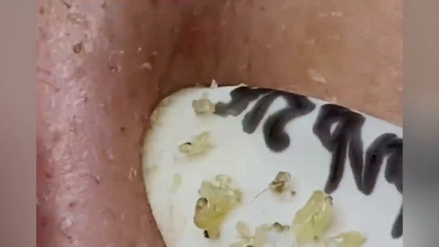 Выдавливание прыщей, угрей, черных точек и камедонов #361