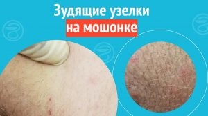 ⏹️ Зудящие узелки на мошонке. Клинический случай №1396