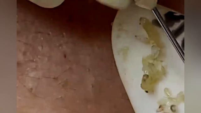 Выдавливание прыщей, угрей, черных точек и камедонов #360