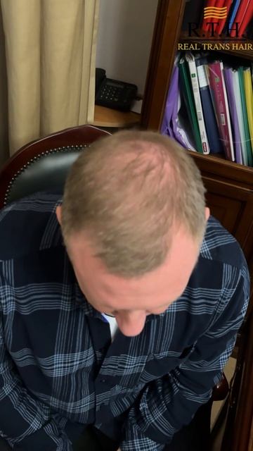 Пересадил волосы 15 лет назад!Отзыв!