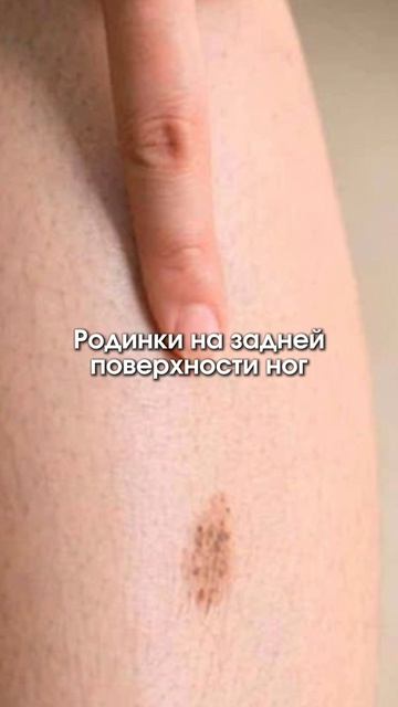 Какие родинки могут быть опасны 