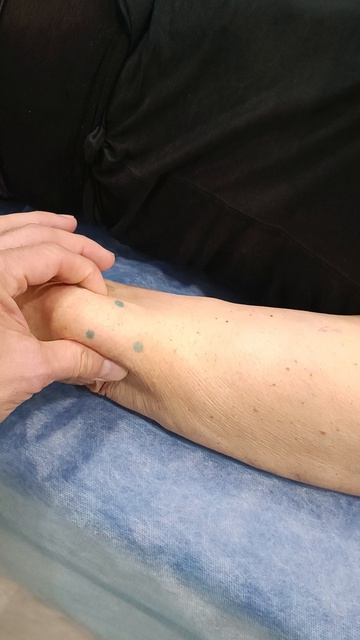 Липоматоз - множественные липомы