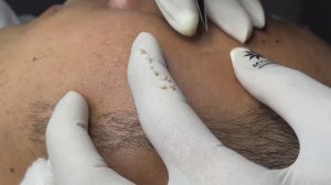 Чистим кожу от угрей и улучшаем текстуру.