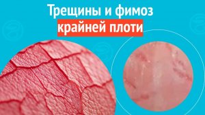 👉 Трещины и фимоз крайней плоти. Клинический случай № 1756