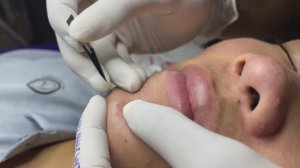 Asmr. Механическое очищение от открытых комедонов.