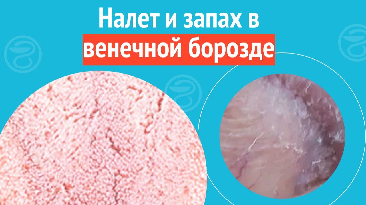 😦 Налет и запах в венечной борозде. Клинический случай №1395 смотреть онлайн