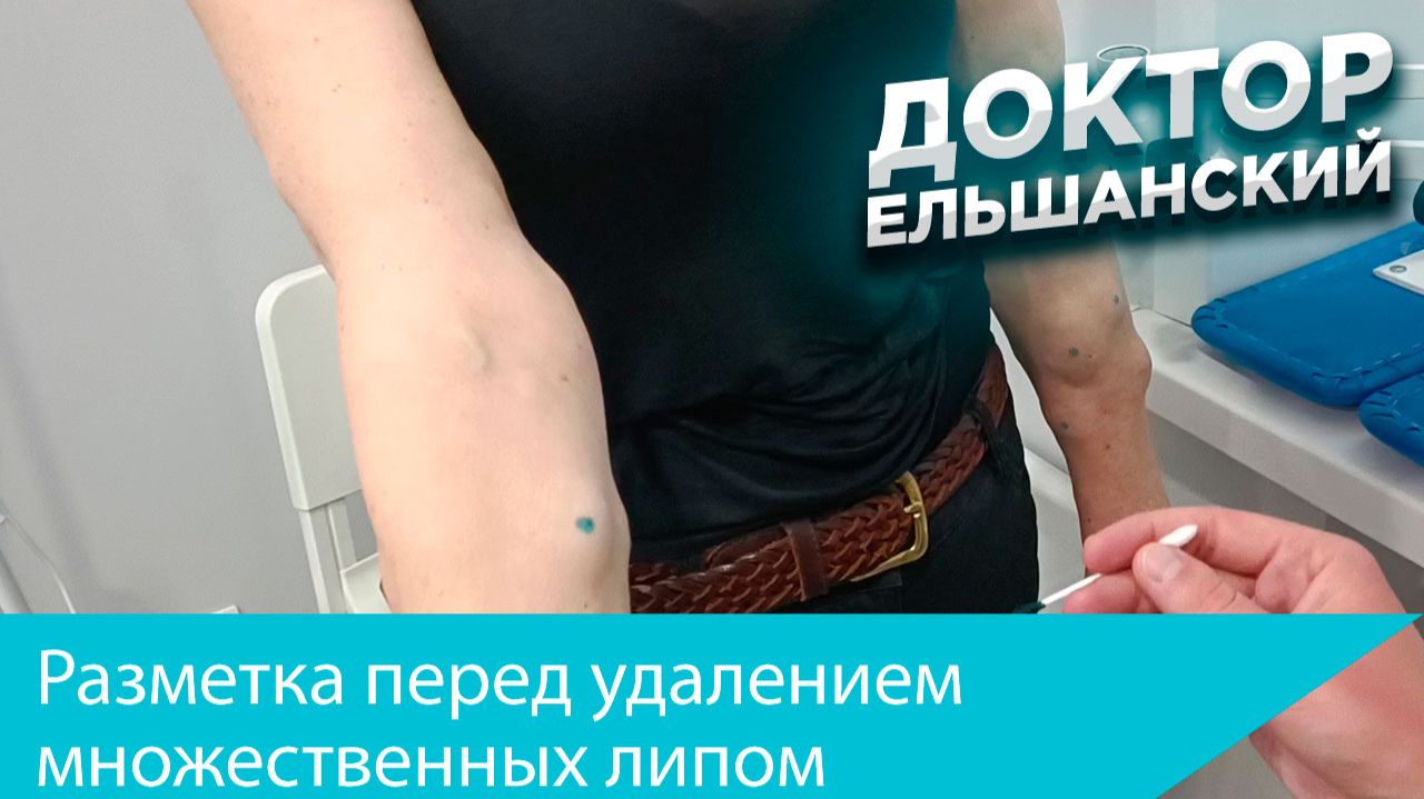 Разметка перед удалением множественных липом