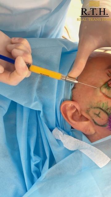 Липомоделирование лица