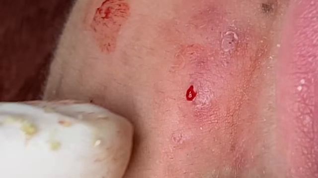 Выдавливание прыщей, угрей, черных точек и камедонов #359