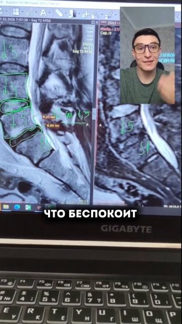 Грыжа на МРТ после операции. #спина #реабилитация #позвоночник #упражнения #больвспине