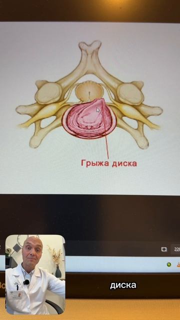 Что такое шейная грыжа диска?