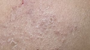 Выдавливаем подкожные угри. Расслабляющий видеоролик.