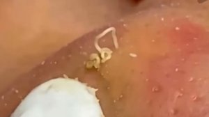 #263 Чистка лица от угрей и акне. Выдавливание прыщей. Удаление черных точек и комедонов